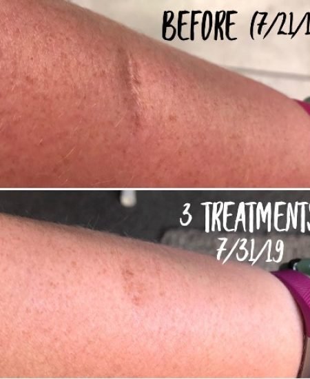 Scar Tissue and Adhesion Treatment